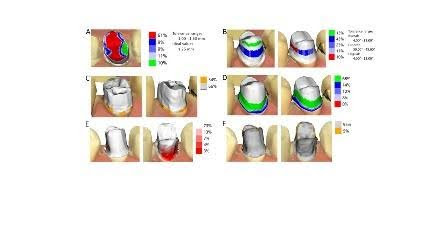 Schéma méthode d'opération de dents en odontologie